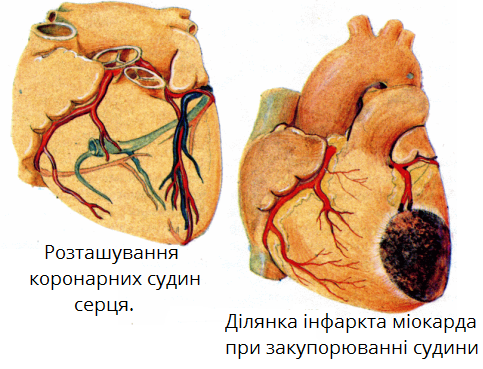 інфаркт.png