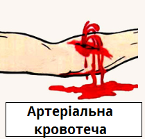 артеріальна кровотечі.png