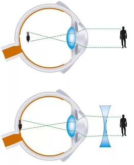 короткозорість.jpg