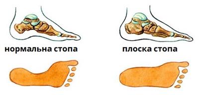 плоскостоп.jpg