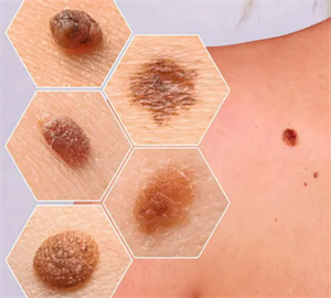 рак шкіри.png