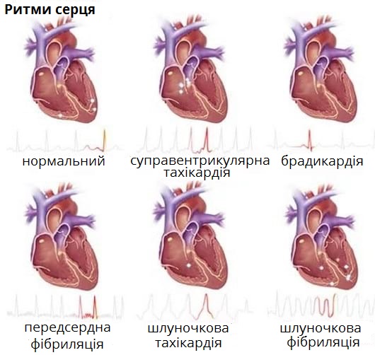 тахікардія1.jpg