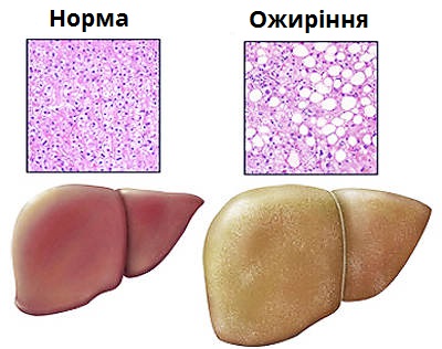 ожиріння_печінка.jpg
