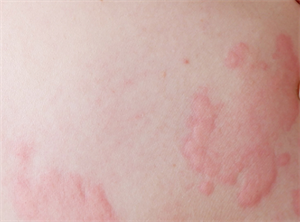 атопічний дерматит.png