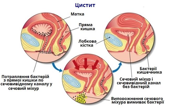 цистит_міхур.jpg