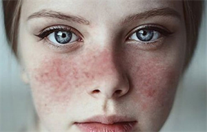 червоний вовчак.png